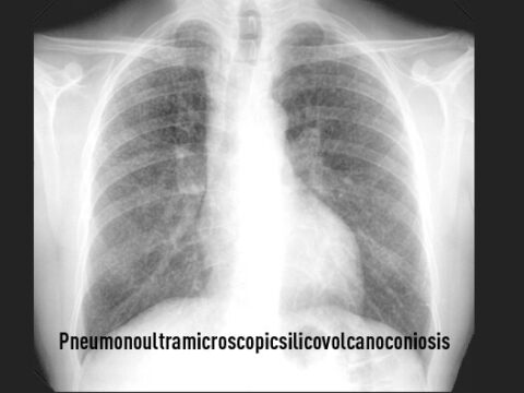 Silicosis X Ray
