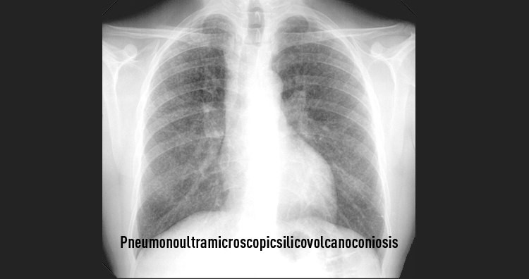 Silicosis X Ray