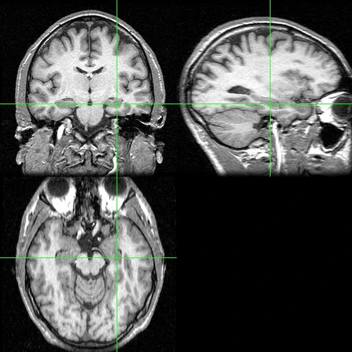Real anatomical MRI scan with the hippocampus indicated